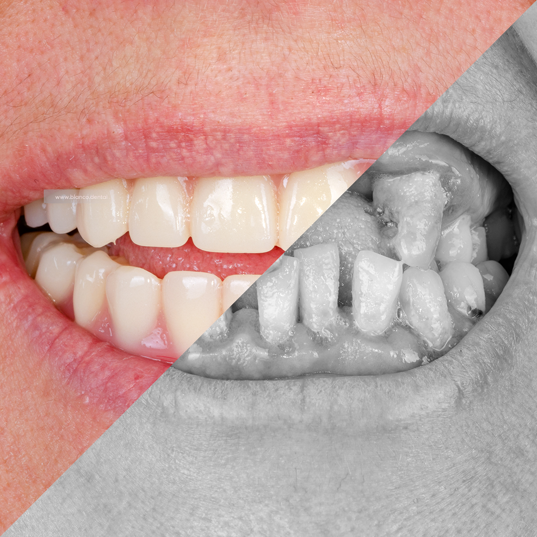 All-on-4 з хірургічними шаблонами