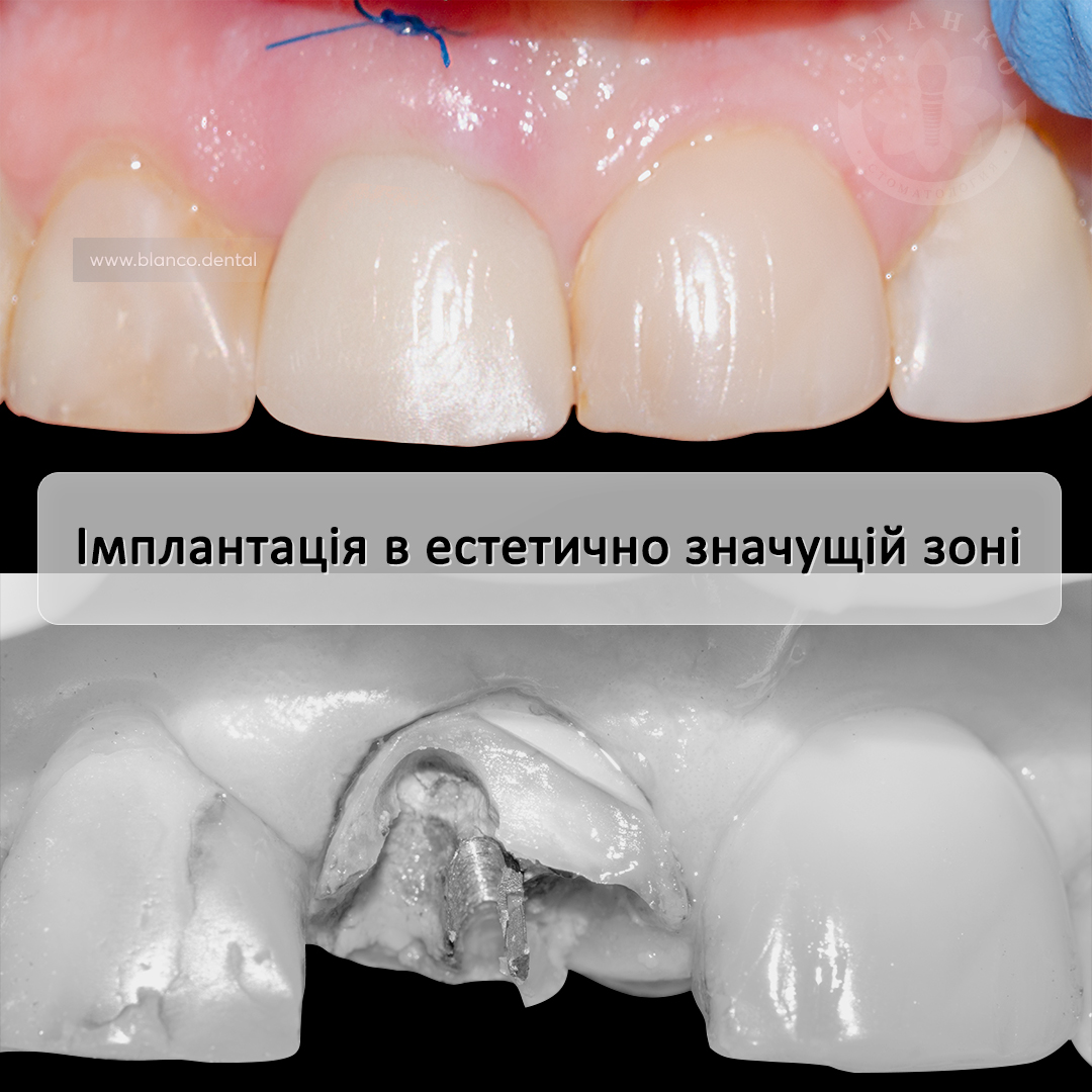 Імплантація переднього зуба