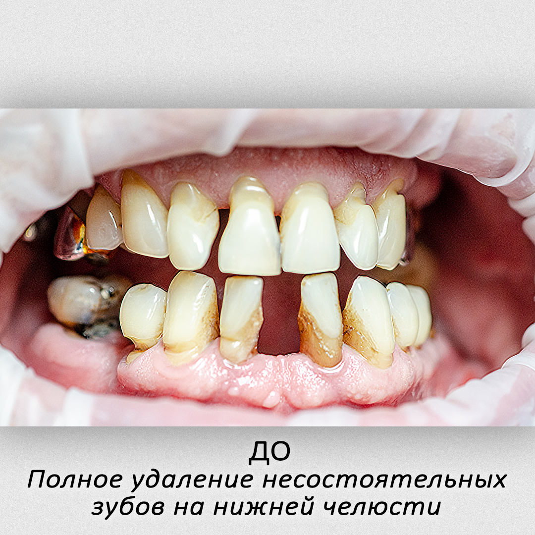 8 імплантів + оксид цирконію