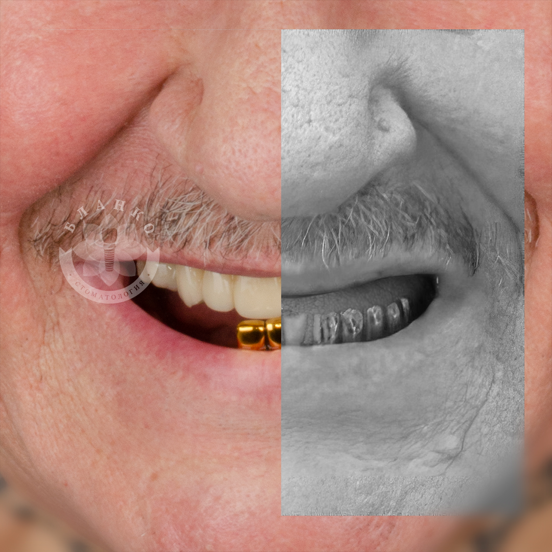 Повна адентія + хірургічний шаблон