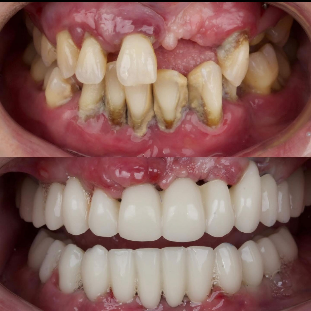 All-on-4 — 3 дні після операції